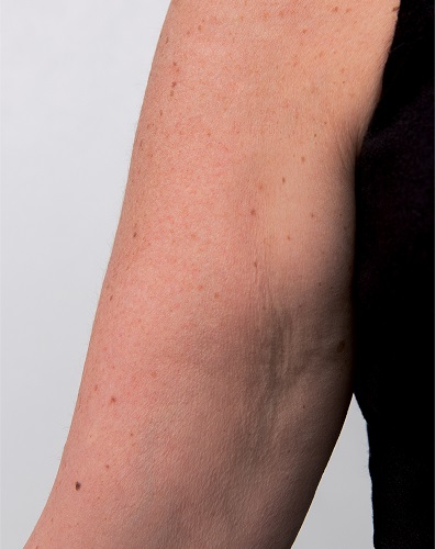 Viscoderm Arm - After